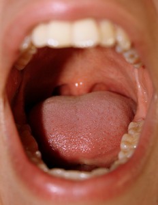 Is Your Mouth Sore Common Or Something More?