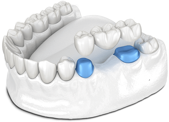 dental bridge model