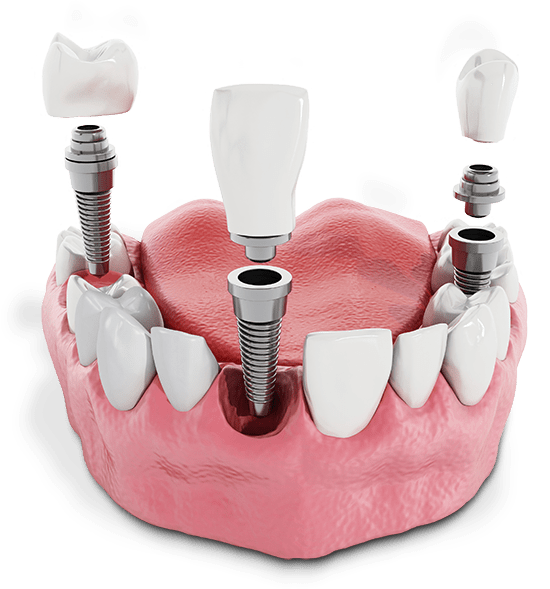multiple dental implant model