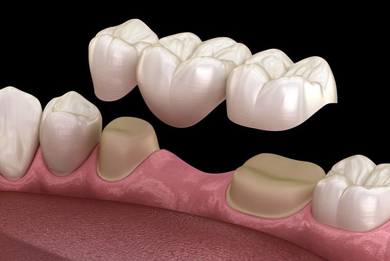Dental bridge example model black background