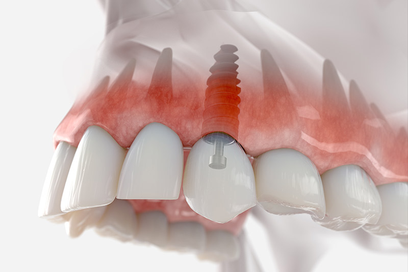 Single dental implant example model