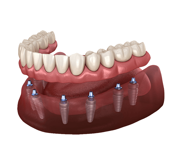 Teeth in one day example model