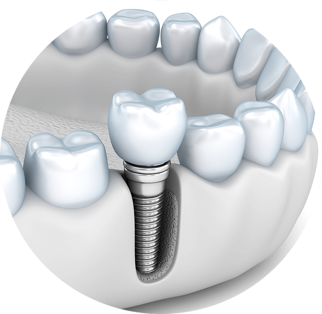 Single dental implant example model