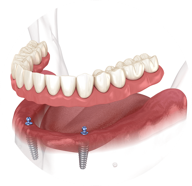 Implant supported denture