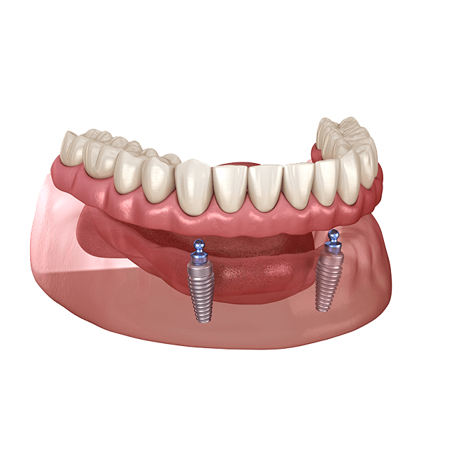 Implant supported denture