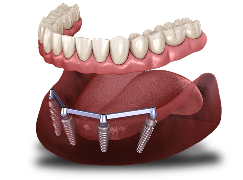 Implant supported dentures example model