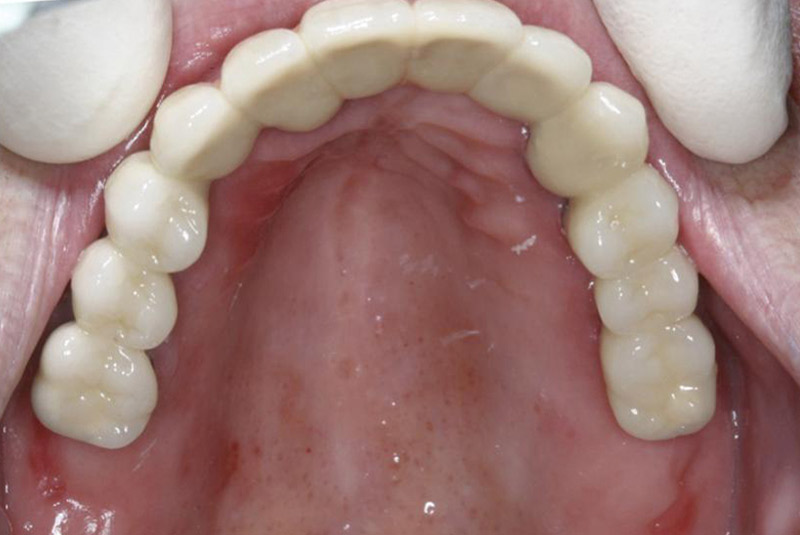 PORCELAIN Implant Teeth