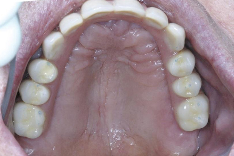 ACRYLIC Implant Teeth